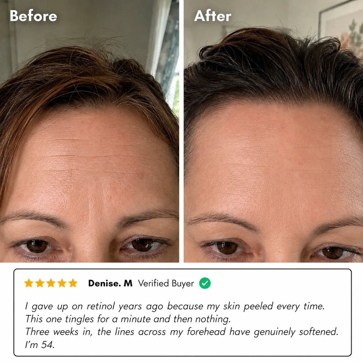 The Vita A Retinal Shot