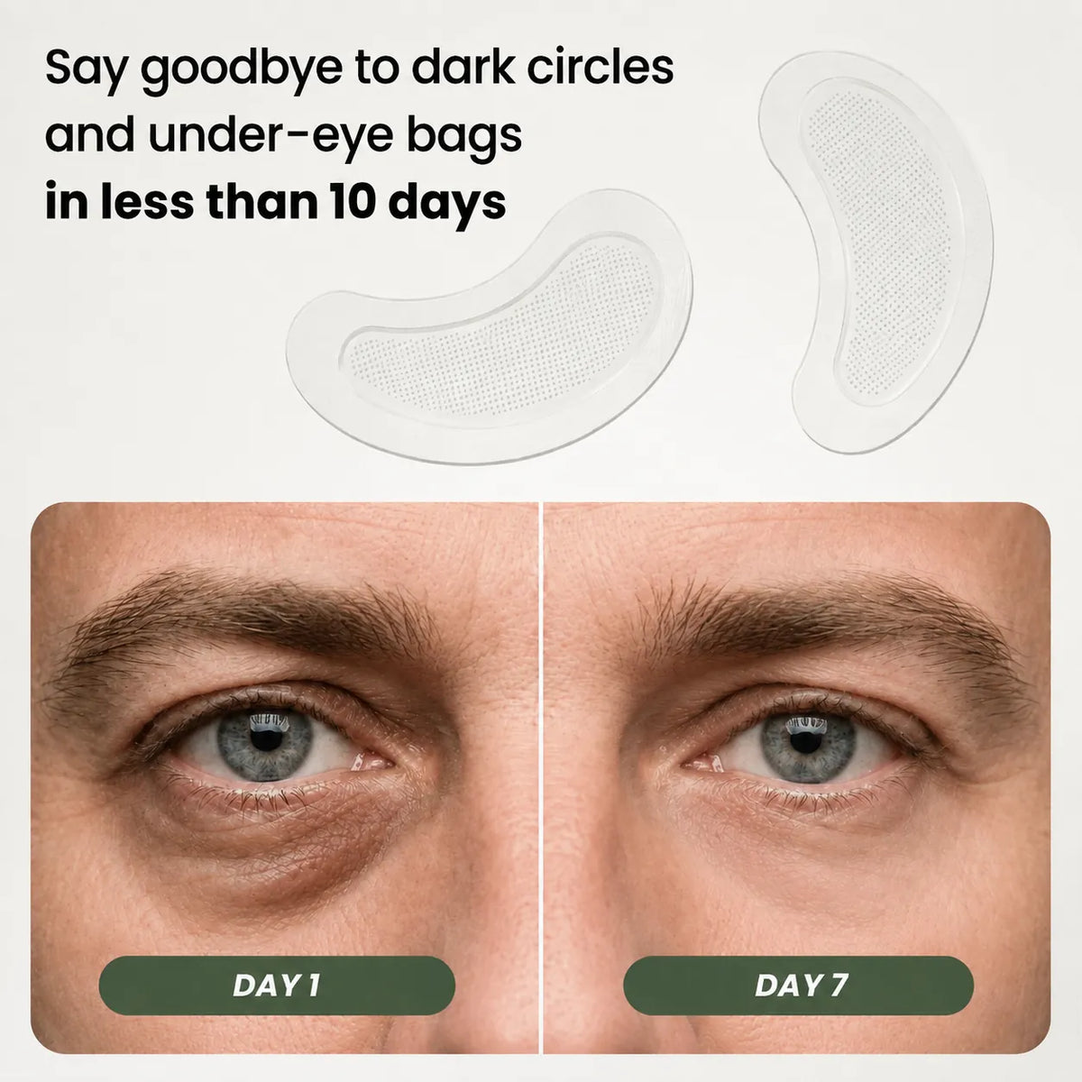 Microneedle Patches - Next Generation