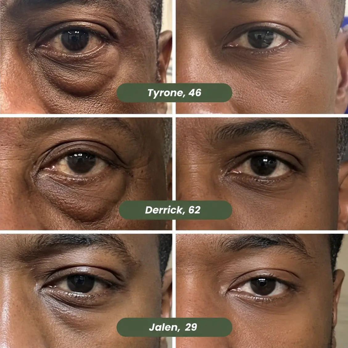 Microneedle Patches - New Generation