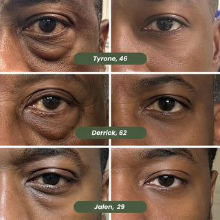 Microneedle Patches - New Generation