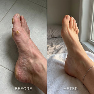Foot Rescue Ointment For Dry, Cracked Feet